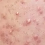 Acne