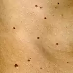 Angioma Senilis