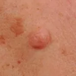 Dermale naevus