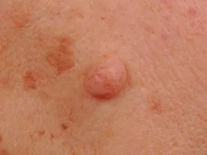 Dermale naevus