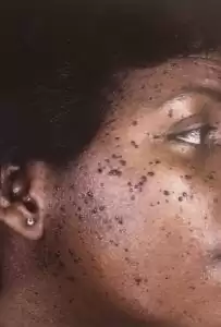 Dermatotis papulosa nigra