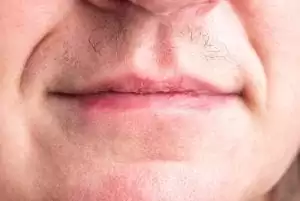 Hirsutisme