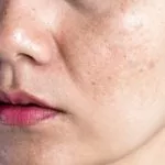Melasma