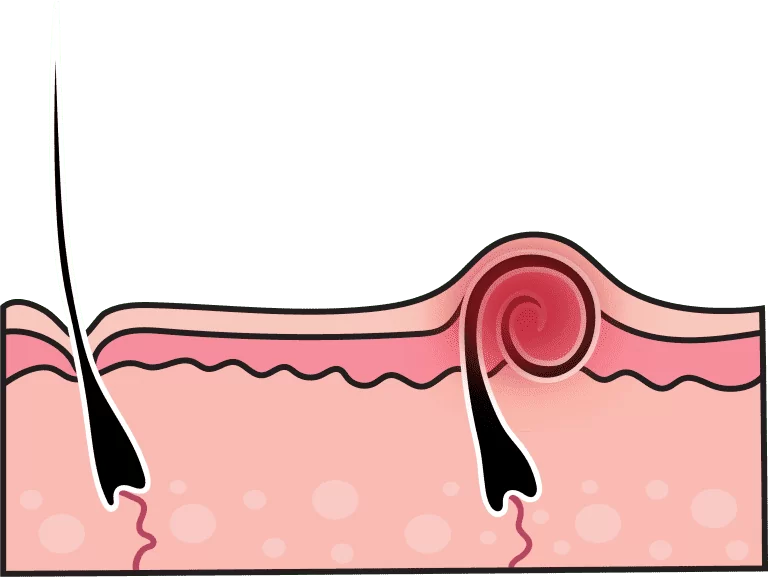 Pseudofolliculitis barbae
