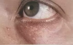 Syringomen