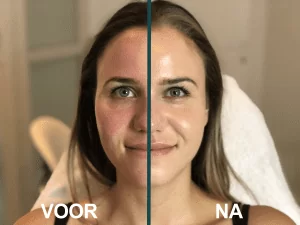 camouflagetherapie voor en na
