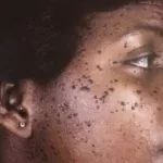 dermatosis papulosa nigra