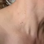 fibromen