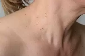 fibromen
