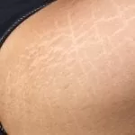 littekens en striae