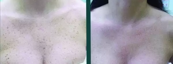 pigment voor en na foto