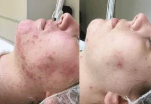 acne voor en na