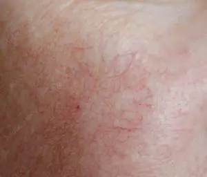 couperose