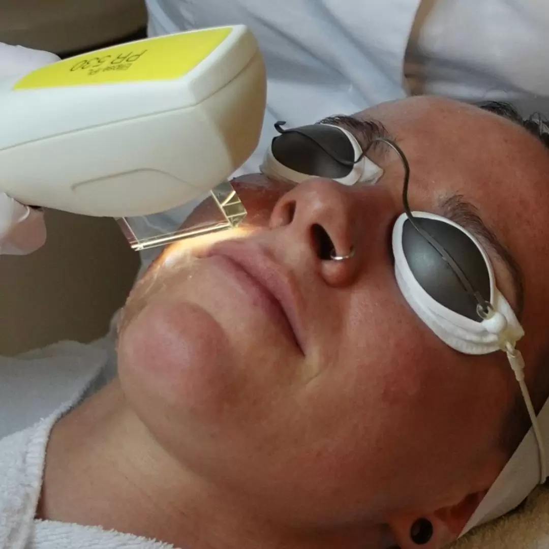 laserbehandeling (IPL)