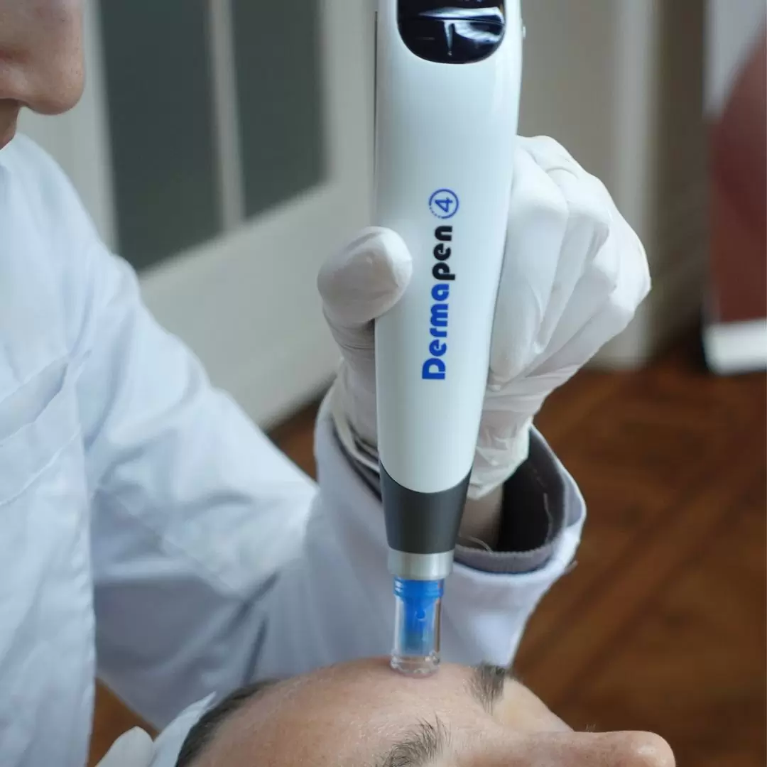 microneedling