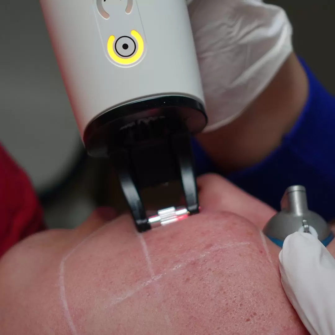 Laserbehandeling (Fractional laser)