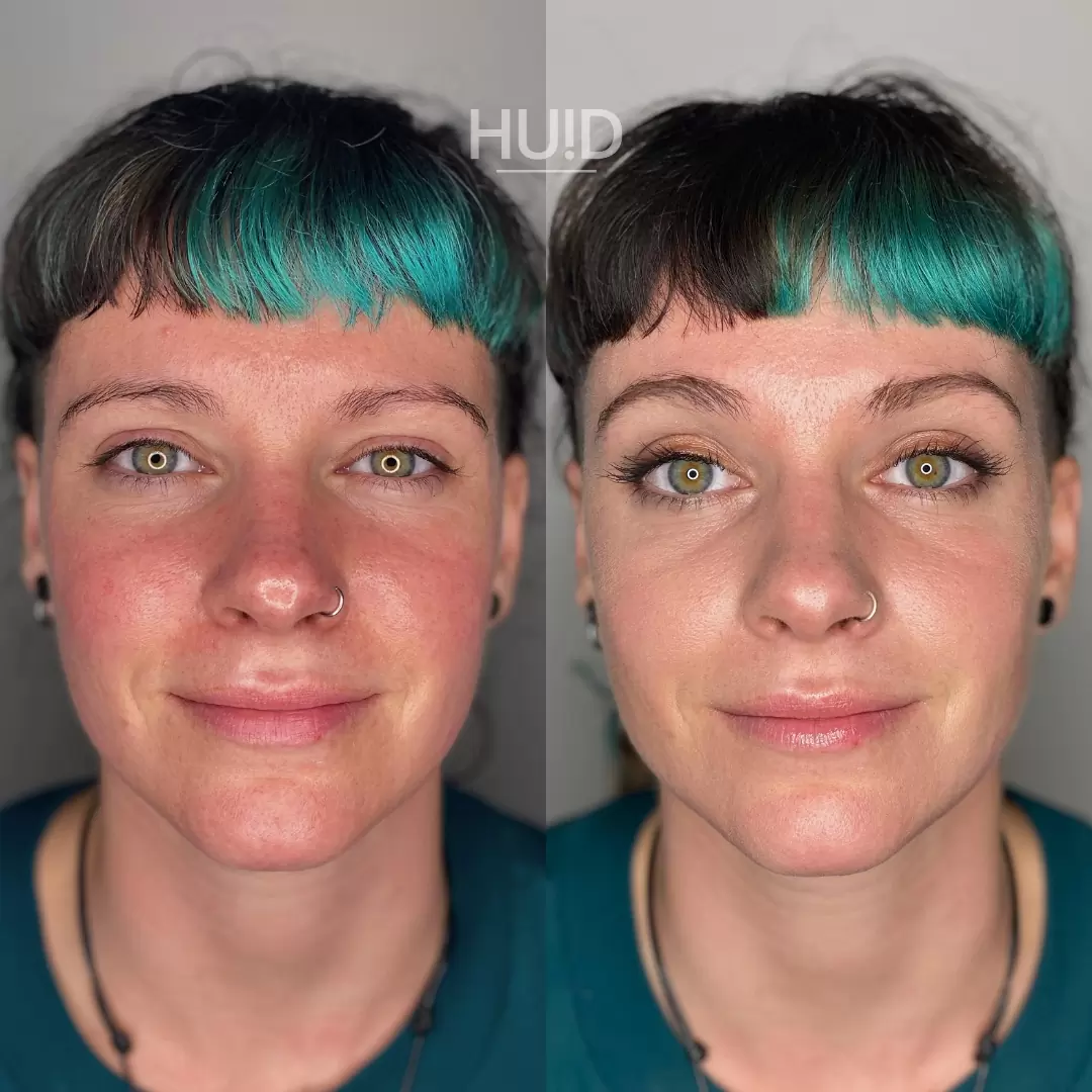 camouflagetherapie_roodheid