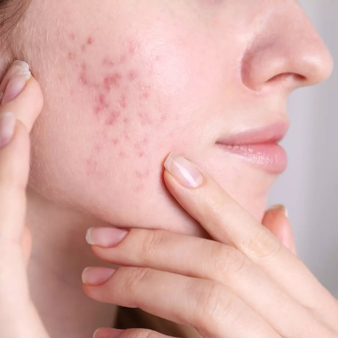 acne littekens