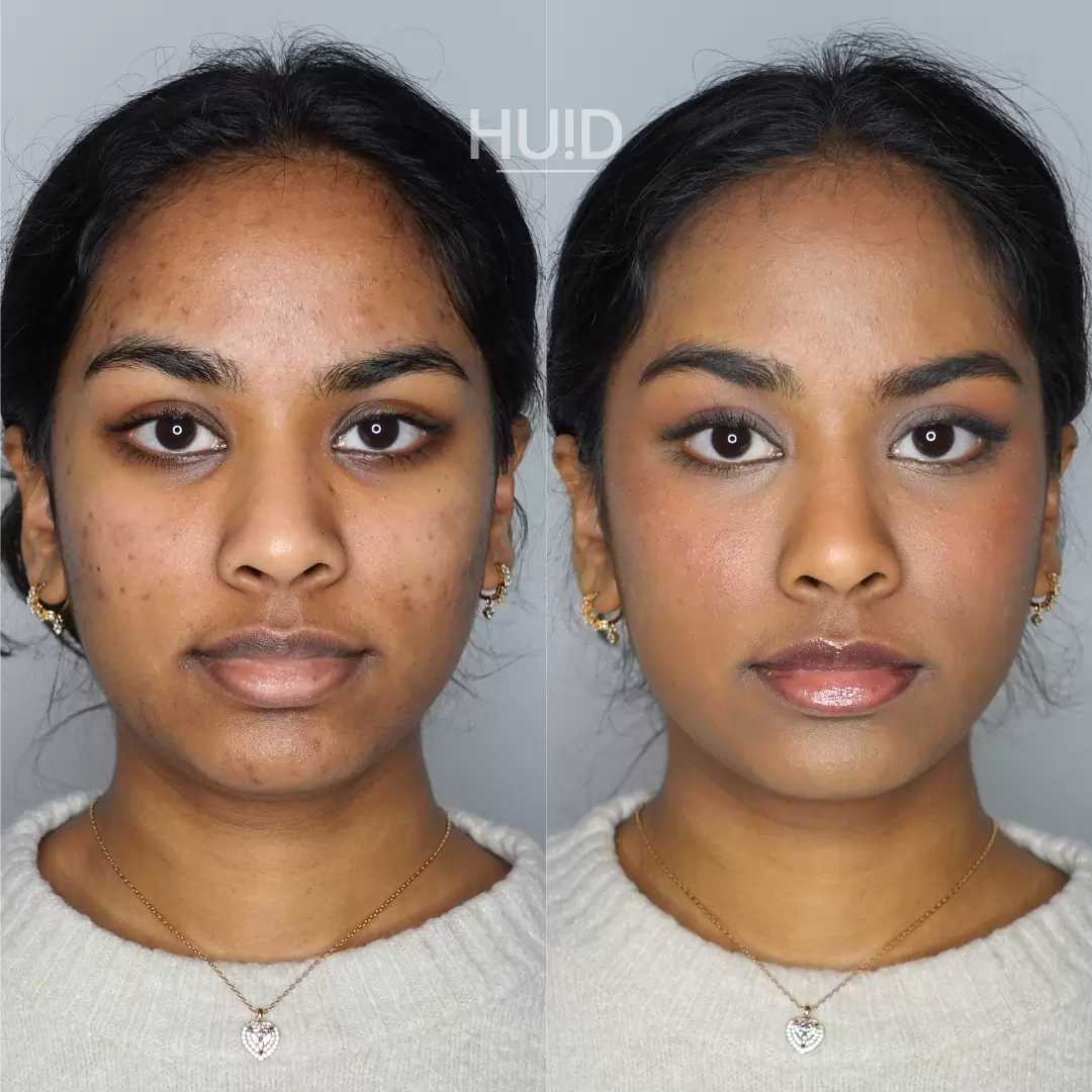 camouflagetherapie_acne