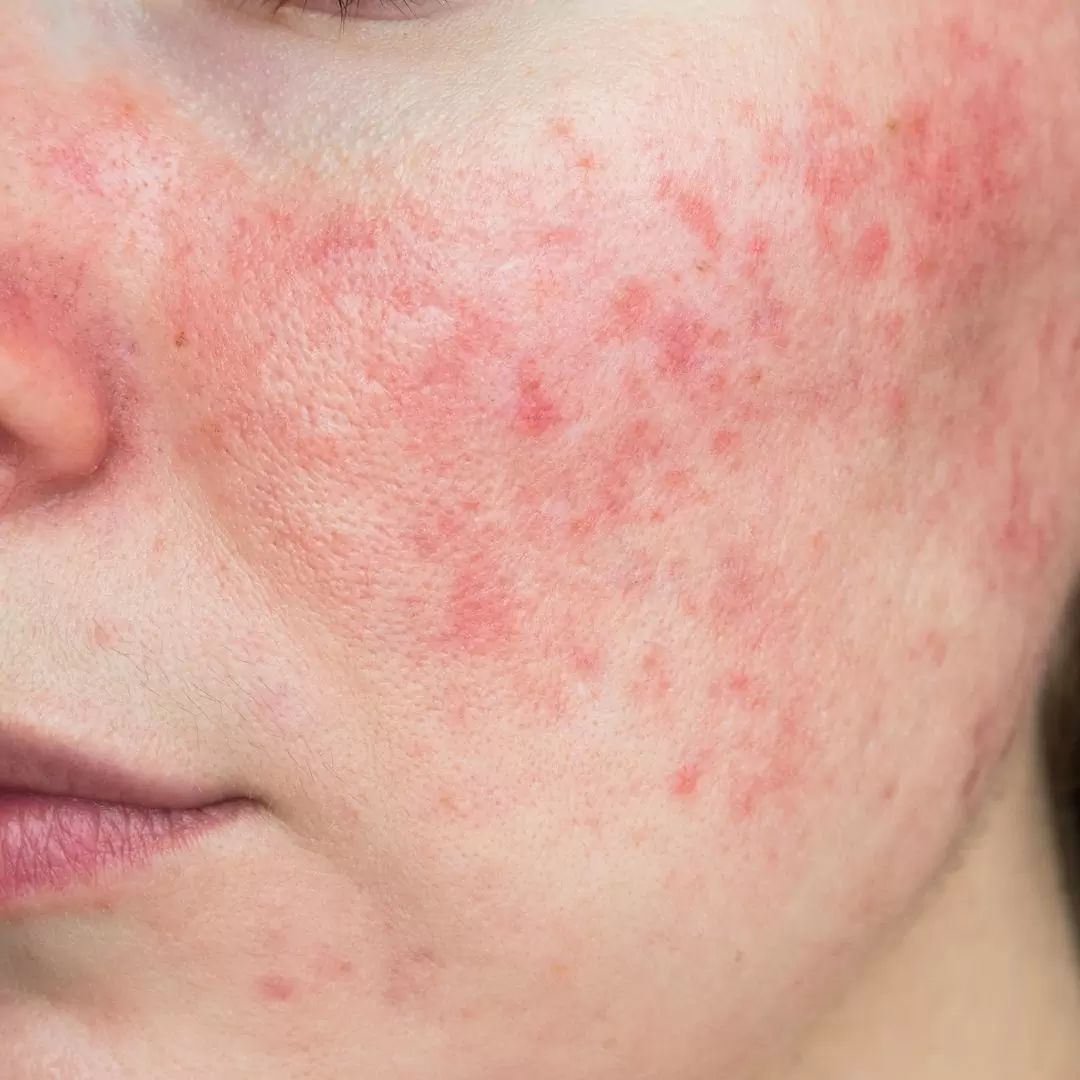 rosacea