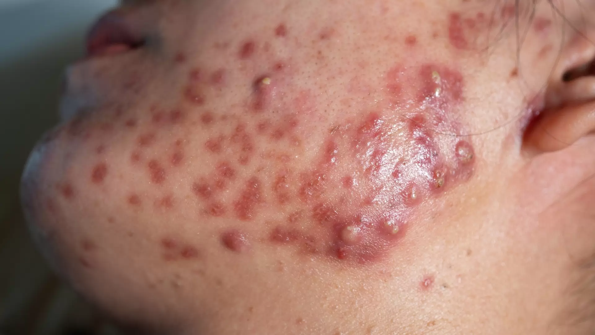 cystische acne
