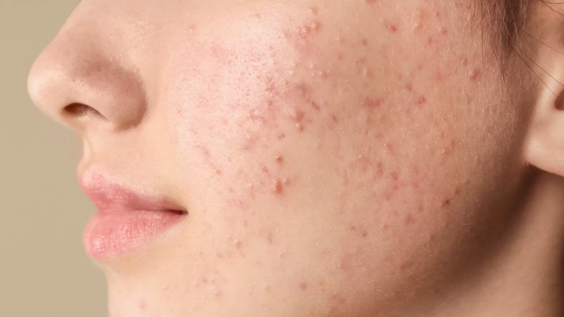 acne vulgaris