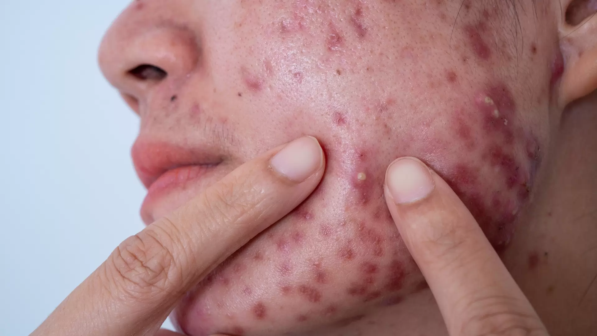 acne conglobata