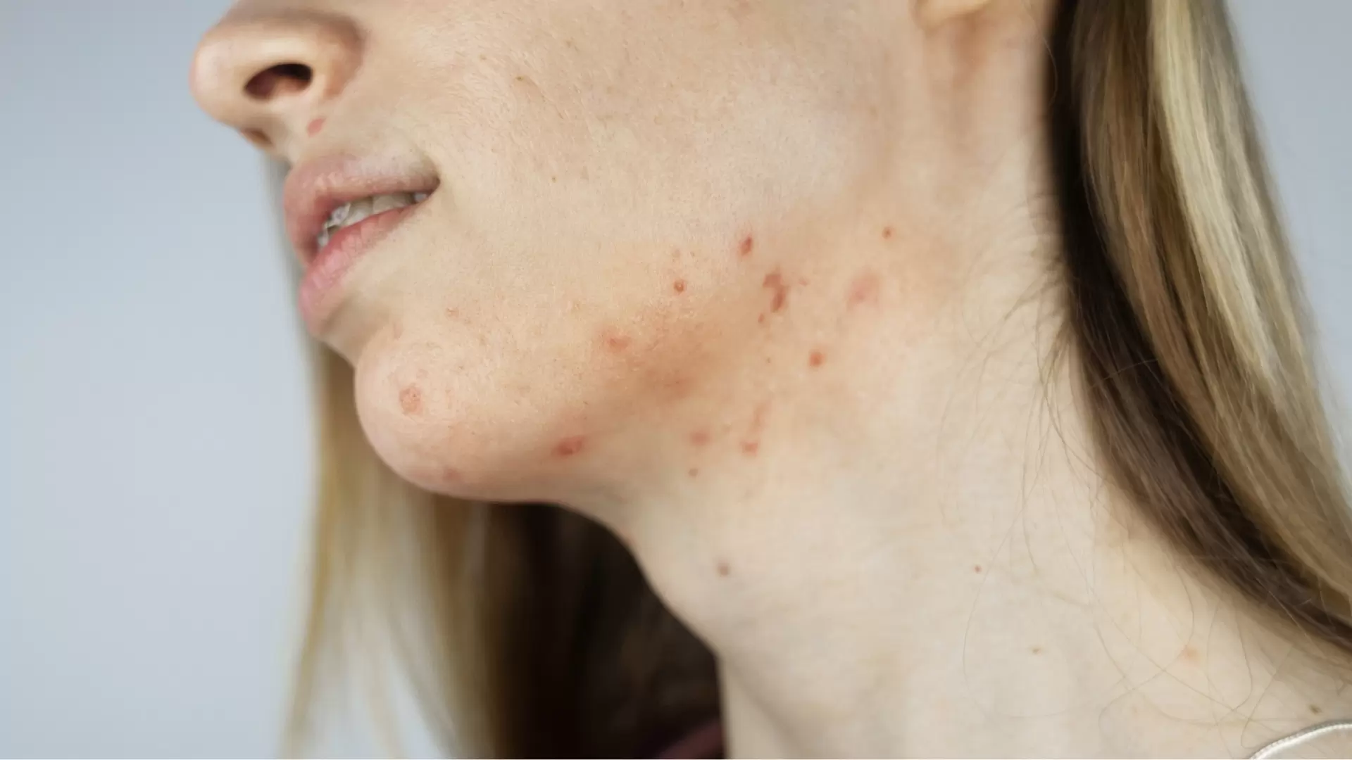 hormonale acne