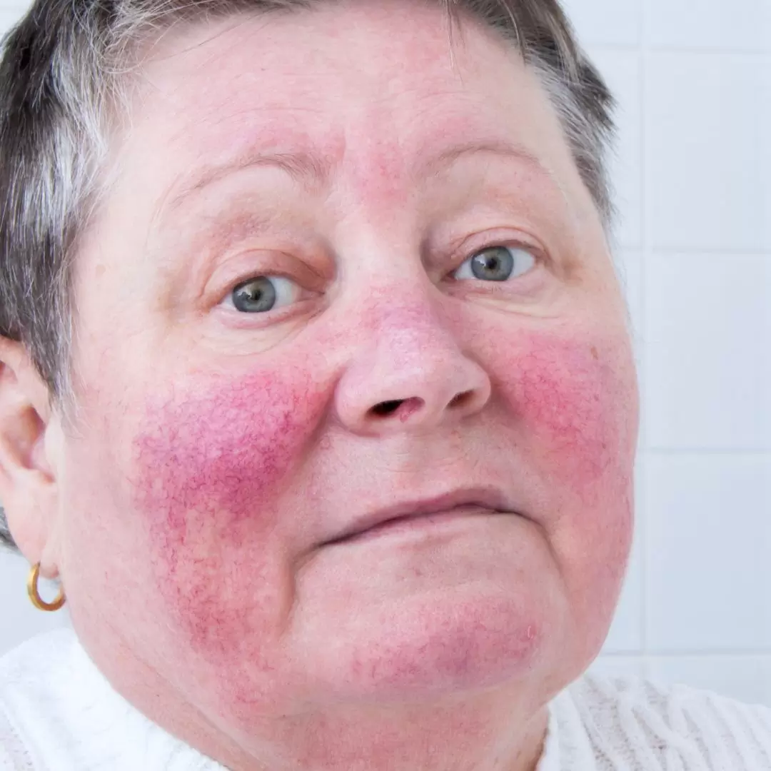 Erythemato-teleangiëctatische rosacea