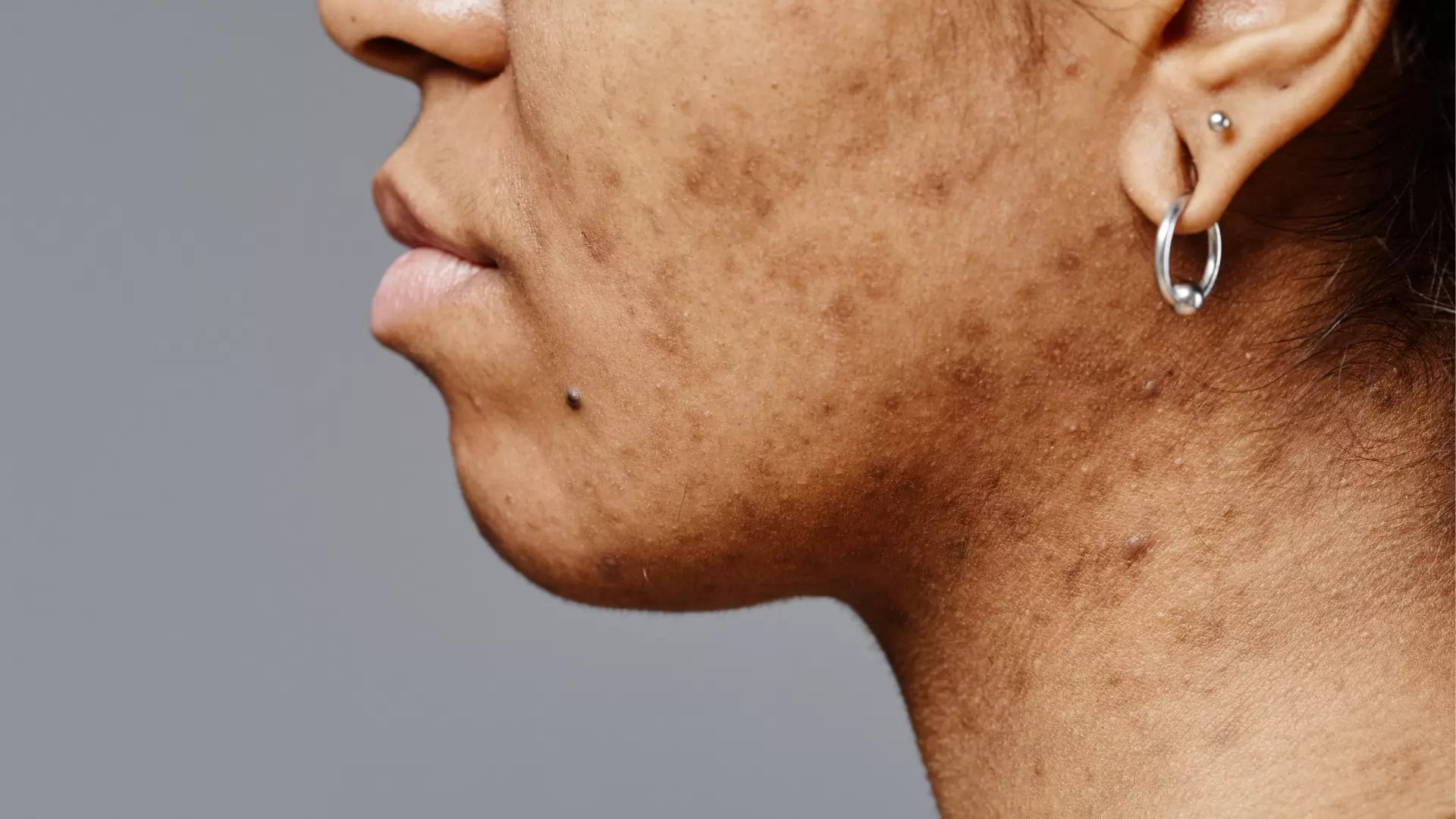 post inflammatoire hyperpigmentatie